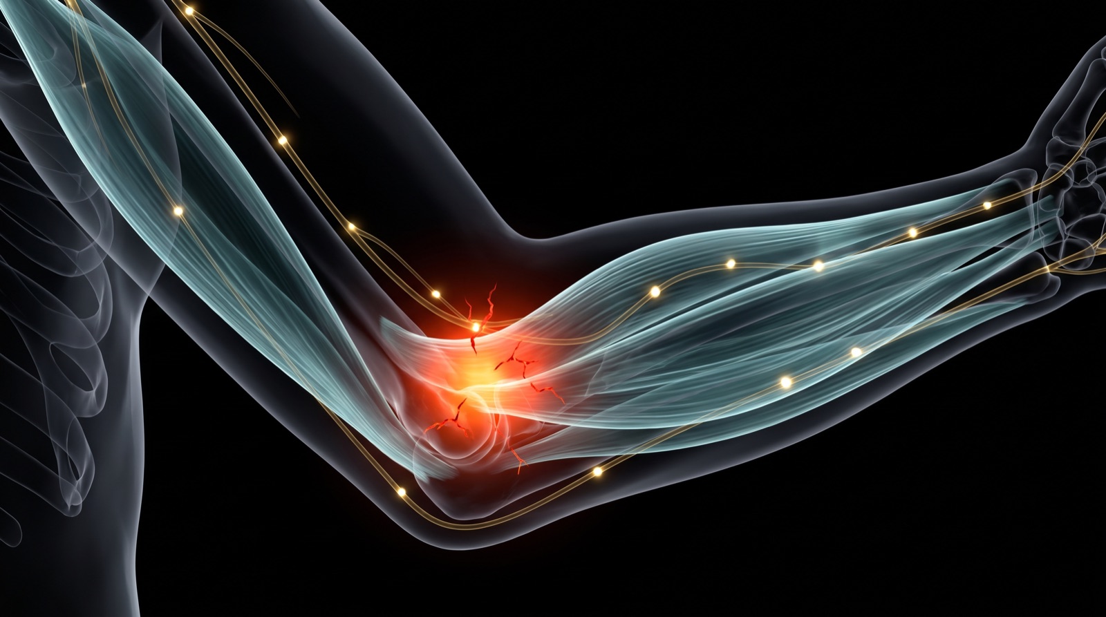 Translucent x-ray anatomical arm bent at the elbow with the inner elbow tendon glowing an inflamed red, teal-blue forearm muscle and gold nerves on a black background