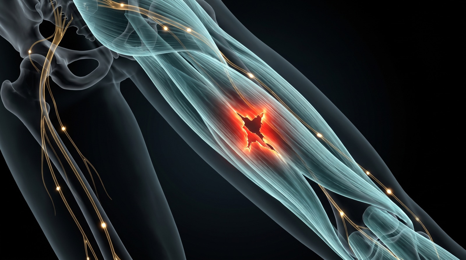 X-ray style anatomical render of the hamstring with an inflamed red tear glowing through the fibres, teal-blue tissue and gold nerves on black